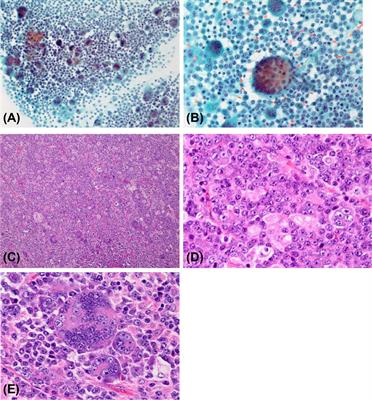 Case report: Plasmablastic neoplasm with multinucleated giant cells—Analysis of stemness of the neoplastic multinucleated giant cells